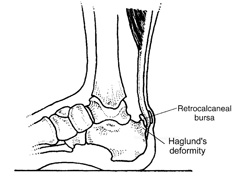 Figure 2: Haglund's deformity refers to a bony prominence on the upper heel. A retroachilles bursitis often forms between the Haglund's and the Achilles tendon.