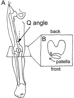 Figure 1A) The Q angle, or quadricep angle, is the angle formed between the upper pelvis, central kneecap and the attachment point of the patella tendon on the tibia. Because a large angle has been theorized to cause knee pain, surgeons occasionally alter this angle by moving its attachment. Figure 1B) A laterally deviated patella tilts outwardly and is subjected to greater pressure as the patella hits the lateral femoral condyle (X).