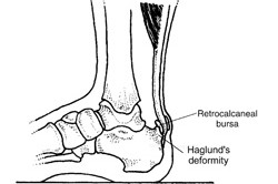 Managing Achilles Tendon Injuries